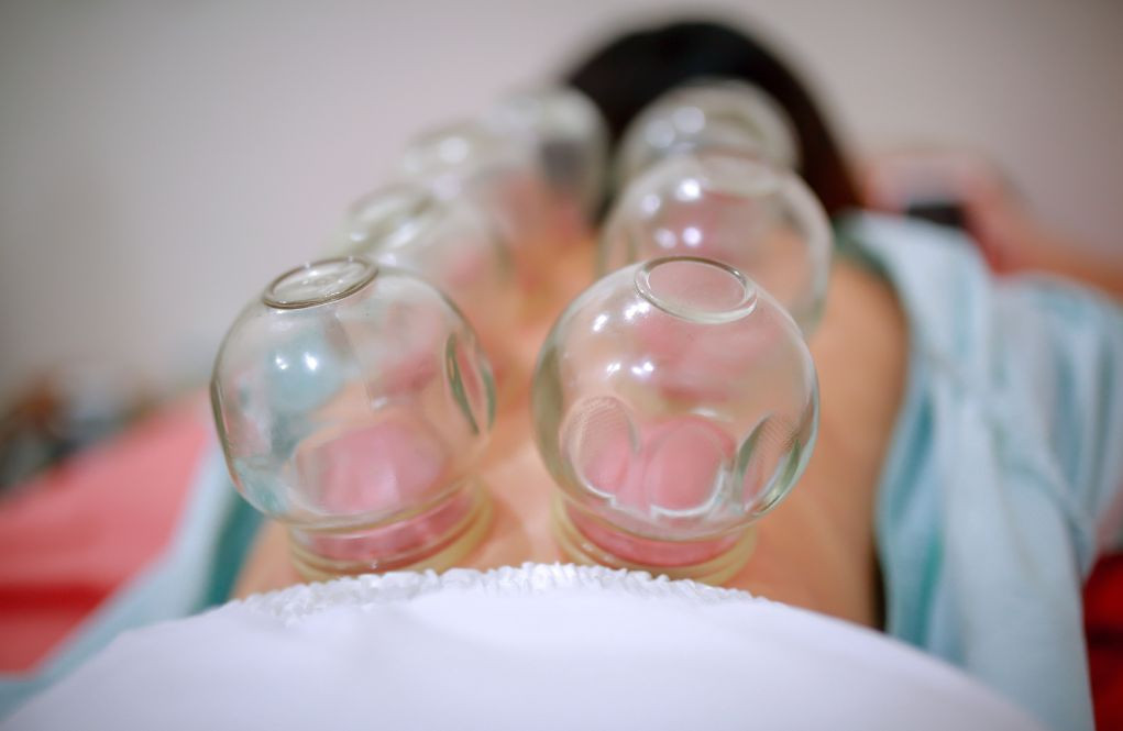 Cupping Therapy - From Our Grandmothers' Techniques to Chinese Medicine